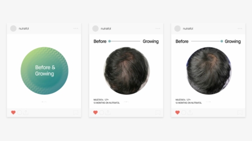 Developed An Instagram Template For Nutrafol’s “before - Lace Wig, HD Png Download, Free Download