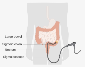 First Sign Of Colon Cancer, HD Png Download, Free Download