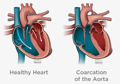Coarcation-aorta - Ventricular Septal Defect, HD Png Download, Free Download