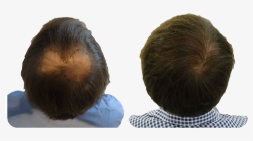 Fue Hair Transplant Scalp, HD Png Download, Free Download
