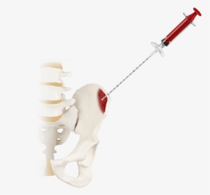 Retrieve® Bone Marrow Aspirate Kit, Syringe Attached - Syringe, HD Png Download, Free Download