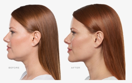 Kybella Double Chin Before And After, HD Png Download, Free Download