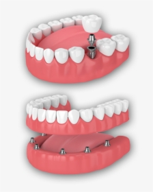 Implants - Molar Implant, HD Png Download, Free Download