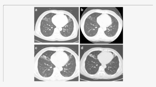 Mycobacterium On Ct Scan, HD Png Download, Free Download