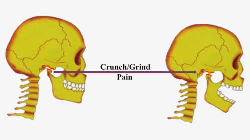 Tmj Jaw Joint Degenerative Joint Diseases - Osteoarthritis, HD Png Download, Free Download