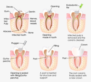 Root Canal Treatment, HD Png Download, Free Download
