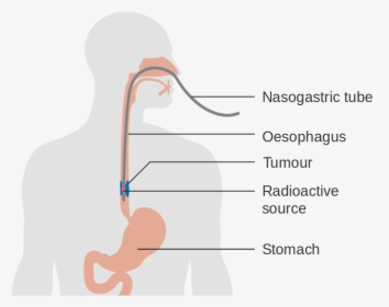 Esophageal Cancer Causes - Illustration, HD Png Download, Free Download