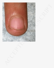 A Photo Of The Patient"s Fingernails, Demonstrating - Leather, HD Png Download, Free Download