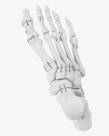 Nitinol Staples Implant Graphic, HD Png Download, Free Download