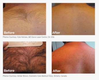 Before & After Mens Laser Hair Removal Back And Shoulders - Tria Beauty Hair Removal Laser 4x Before, HD Png Download, Free Download