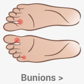 Bunions - Bump Under Big Toe Joint, HD Png Download, Free Download