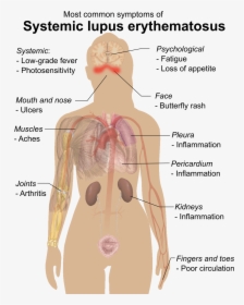 Symptoms Of Sle - Systemic Lupus Erythematosus, HD Png Download, Free Download