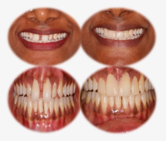 Teeth Gap Filling Cost In India,chennai - Tooth Bleaching, HD Png Download, Free Download