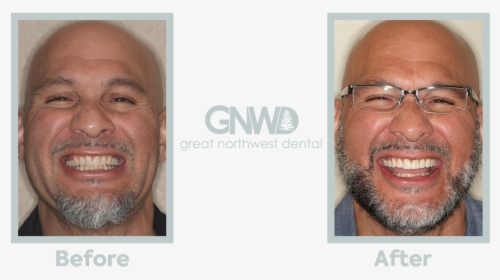 Emery - Invisalign Before And After Wdult, HD Png Download, Free Download