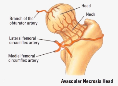 Ligamentum Teres Artery Avascular Necrosis, HD Png Download, Free Download