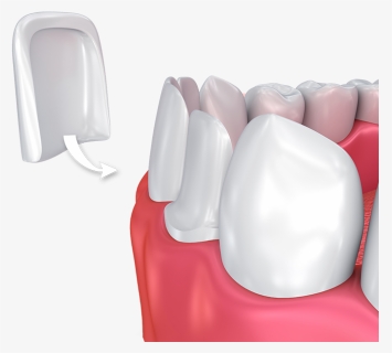 Porcelain Veneers - Dental Veneers Png, Transparent Png, Free Download