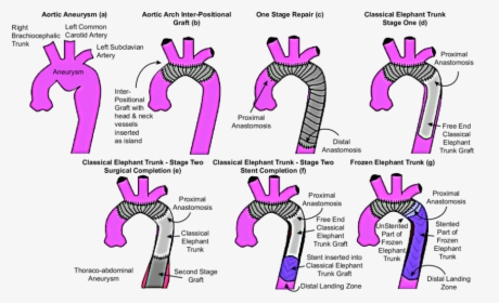 Graphical Representation Of Different Techniques For - Elephant Trunk Surgery, HD Png Download, Free Download