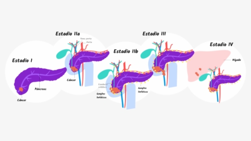 4 Stages Of Pancreatic Cancer, HD Png Download, Free Download