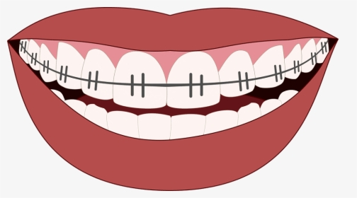 Braces Teeth Clipart Png, Transparent Png, Free Download