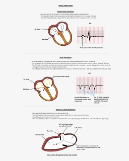 Atrial Fibrillation And Atrial Depolarization, HD Png Download, Free Download