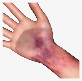 Bruise Png, Transparent Png, Free Download