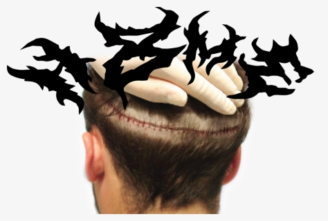 H8me Head Split Copy - Hair Transplant Scar, HD Png Download, Free Download