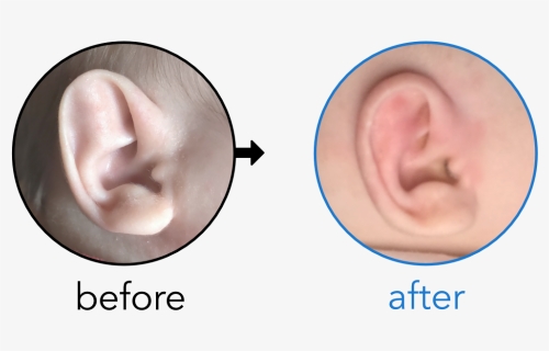Baby"s Ear Folded Like An Elf Ear - My Baby Before After, HD Png Download, Free Download