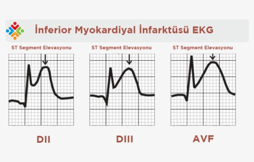 Myocardial Infarction Ekg After Heart Attack, HD Png Download, Free Download