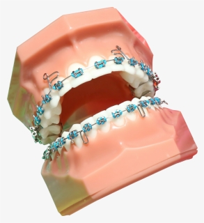 Transparent Braces Png - Rodzaje Aparatów Ortodontycznych Stałych, Png Download, Free Download