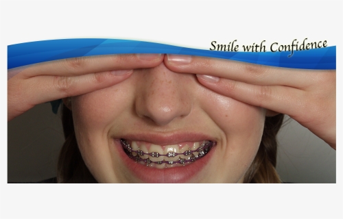 Life With Braces - Braces Teeth For Athletes, HD Png Download, Free Download