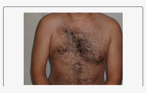 Pectoral Atrophy, HD Png Download, Free Download