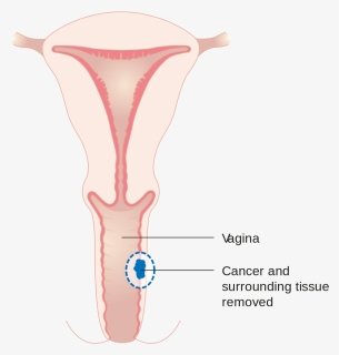 Vajina Cancer, HD Png Download, Free Download