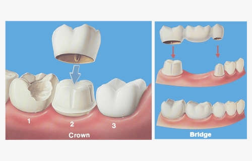 Crown Bridge Hobe Sound Dentist - Dental Crown And Bridge, HD Png Download, Free Download