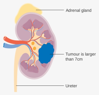 Kidney Cancer Diagram , Png Download - Illustration, Transparent Png, Free Download