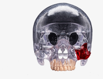 3d Printed Head Skull Transparent Surgical Guide - 3d Printing, HD Png Download, Free Download