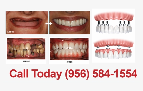 New Smile In 1 Day - Implante Dental, HD Png Download, Free Download
