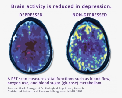 Pet Scan On Depression, HD Png Download, Free Download