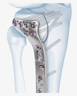 Proximal Tibial Locking Plate, HD Png Download, Free Download