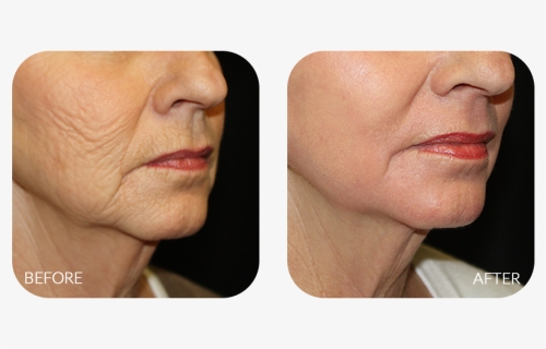 Chemical Peel Neck Before And After, HD Png Download, Free Download