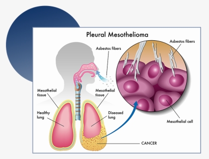 Mesothelioma Lung Cancer, HD Png Download, Free Download