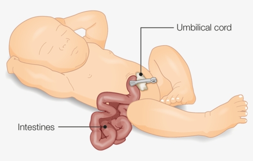 Illustration Of A Baby With Gastroschisis Showing Intestine - Cartoon, HD Png Download, Free Download