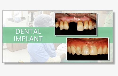 Dental-implant - Dentures, HD Png Download, Free Download