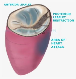 In Ischemic Mitral Regurgitation Or Leakage From Damage - Mouth, HD Png Download, Free Download