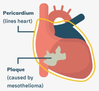 Pericardial Mesothelioma, HD Png Download, Free Download