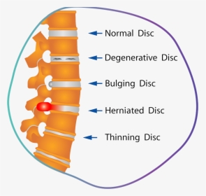 Herniated Disc Physical Therapy, HD Png Download, Free Download