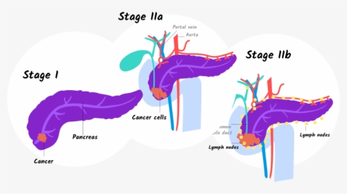 Illustration Of Stage I And Stage Iia And Iib Pancreatic - Stage 1 Early Stage Pancreatic Cancer, HD Png Download, Free Download