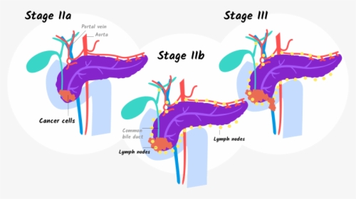 Illustration Of Stage Iia, Iib, And Stage Iii Pancreatic - Cancer Of Pancreas Stage 4, HD Png Download, Free Download