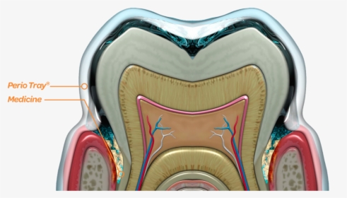 Periodontal Pocket Cross Section, HD Png Download, Free Download