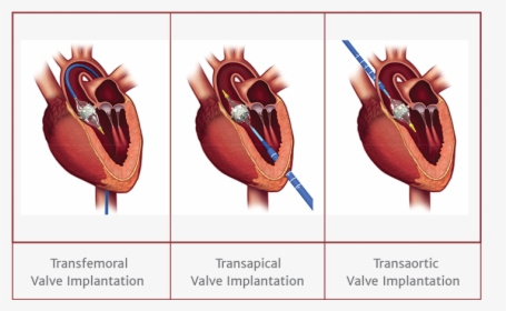 Aortic Stenosis New Treatment Options - Transcatheter Aortic Valve Replacement, HD Png Download, Free Download