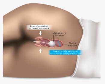 Esophageal And Anorectal Manometry - Anorectal Manometry, HD Png Download, Free Download